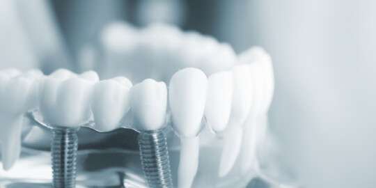 Neue Methodik für den Vergleich von Dental-Implantaten: MRL Advisors stellt Innovation auf der EAO vor